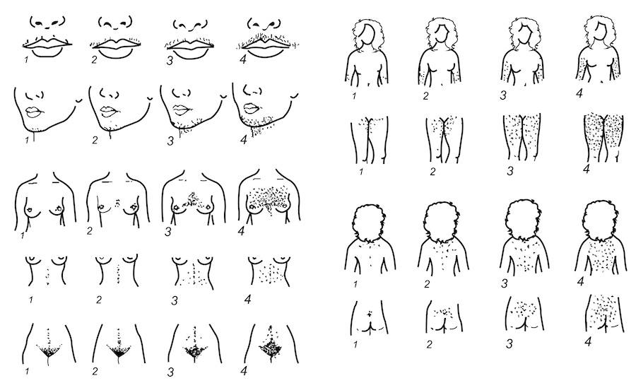 Hirsutism scoring system of Ferriman and Gallwey. The nine body areas possessing androgen-sensitive pilosebaceous units are graded from 0 (no terminal hair) to 4 (frankly virile)