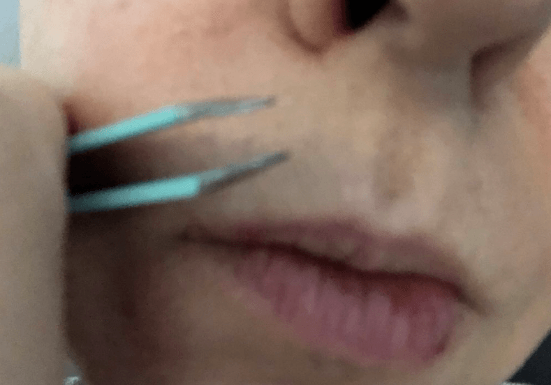 upper lip hair removal