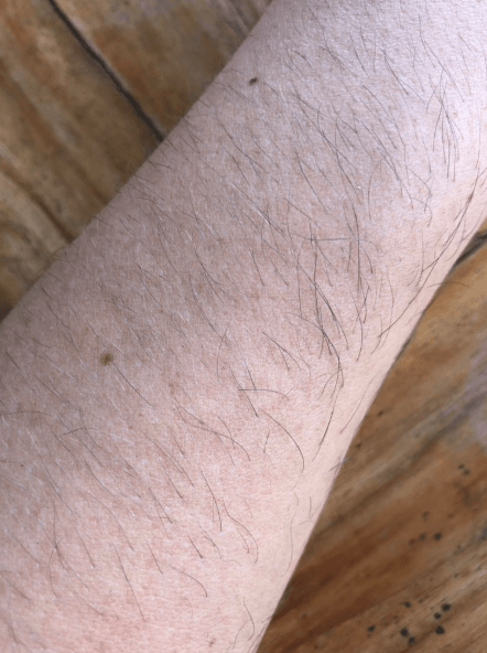 How To Make Arm Hair Less Noticeable Myhirsutism Com