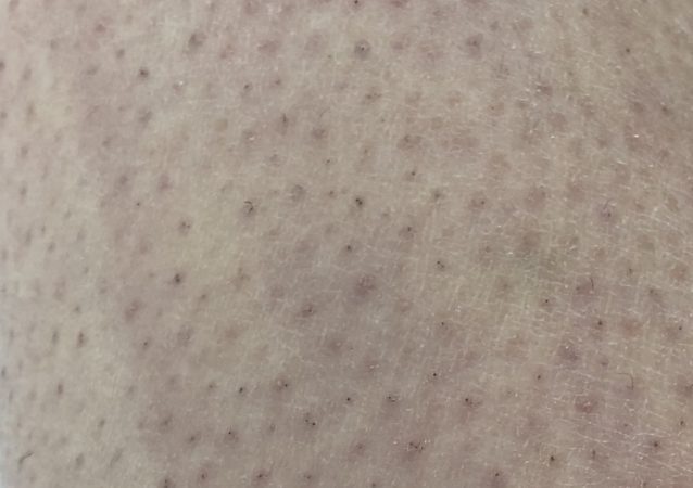 Razor Bumps and Strawberry Legs: How to Prevent and Treat Them ...