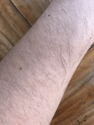 How to Make Arm Hair Less Noticeable | myHIRSUTISM.com