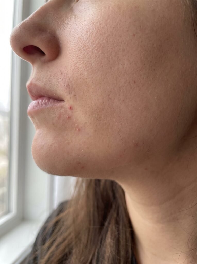 Hormonal acne and fine hairs along a woman’s jawline